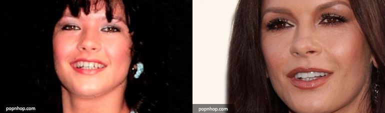 implant resim catherine zeta jones