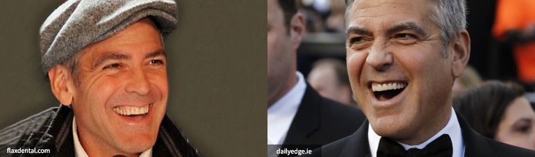implant resim george clooney