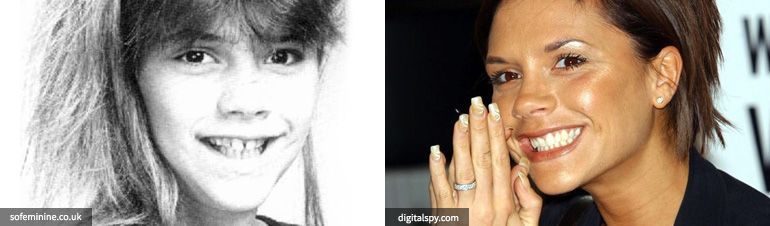 implant resim victoria beckham